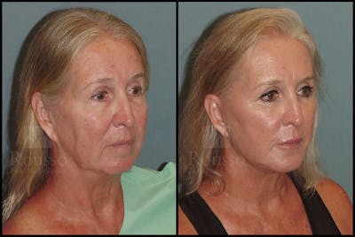 Facelift Before & After Gallery - Patient 24558554 - Image 1