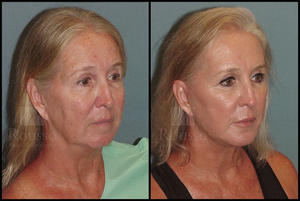 Facelift Before & After Gallery - Patient 24558554 - Image 1
