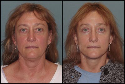 Facelift Before & After Gallery - Patient 24558553 - Image 2