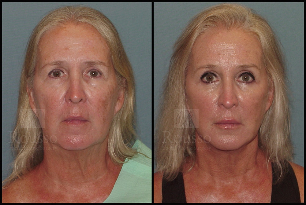 Facelift Before & After Gallery - Patient 24558554 - Image 3