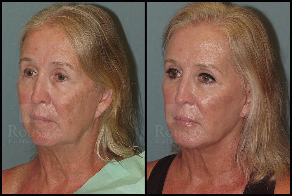 Facelift Before & After Gallery - Patient 24558554 - Image 2