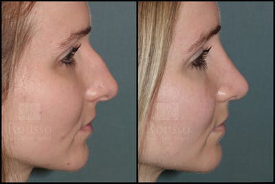 Rhinoplasty Before & After Gallery - Patient 25134122 - Image 1