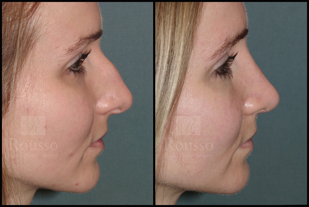 Rhinoplasty Before & After Gallery - Patient 25134122 - Image 3