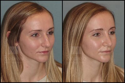 Rhinoplasty <span class=small>By Dr. Daniel Rousso</span> Before & After Gallery - Patient 25134122 - Image 2