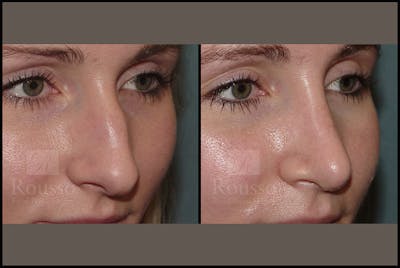 Rhinoplasty Before & After Gallery - Patient 25134122 - Image 2