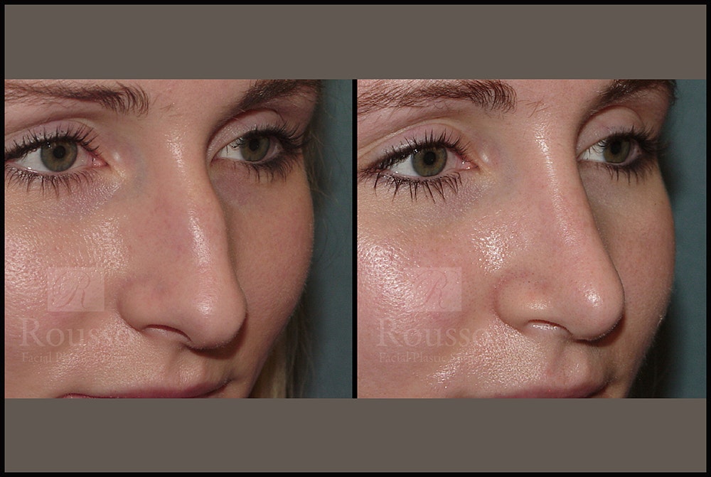 Rhinoplasty <span class=small>By Dr. Daniel Rousso</span> Before & After Gallery - Patient 25134122 - Image 3