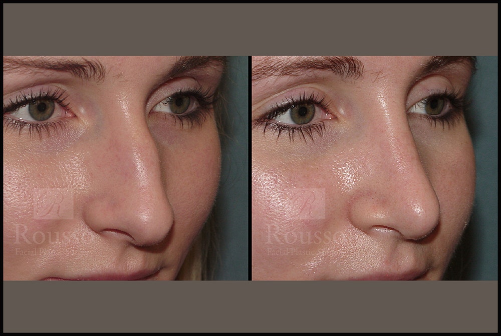 Rhinoplasty Before & After Gallery - Patient 25134122 - Image 3