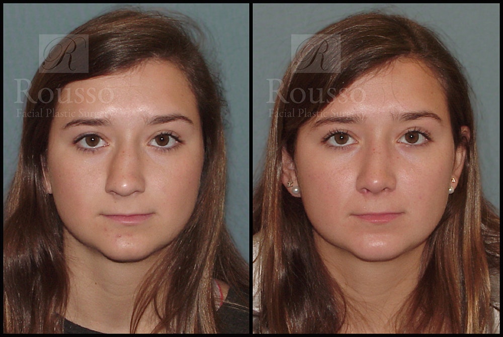 Rhinoplasty Before & After Gallery - Patient 25136023 - Image 3
