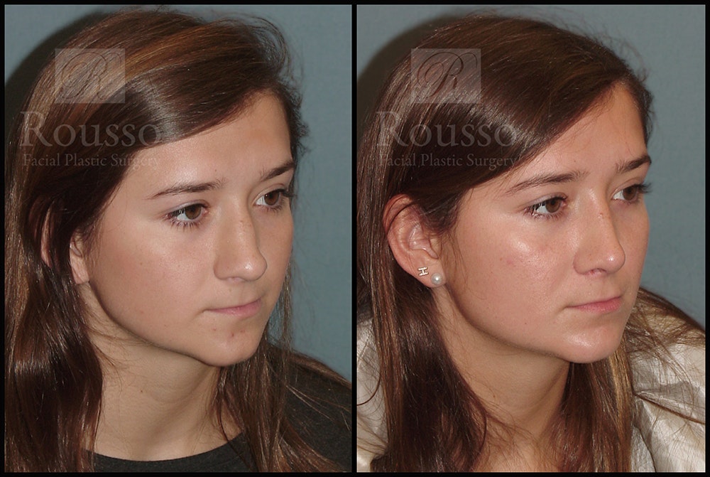 Rhinoplasty <span class=small>By Dr. Daniel Rousso</span> Before & After Gallery - Patient 25136023 - Image 2