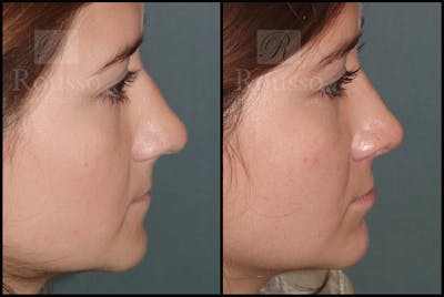 Rhinoplasty <span class=small>By Dr. Daniel Rousso</span> Before & After Gallery - Patient 25136023 - Image 1