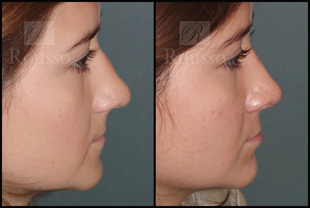 Rhinoplasty Before & After Gallery - Patient 25136023 - Image 1