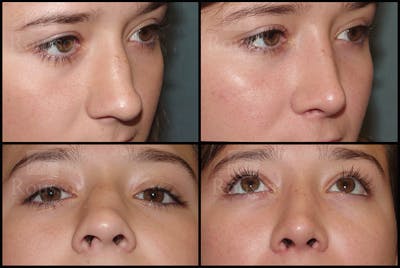 Rhinoplasty Before & After Gallery - Patient 25136023 - Image 4