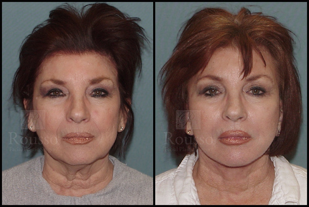 Facelift Before & After Gallery - Patient 25136041 - Image 3