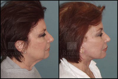 Facelift Before & After Gallery - Patient 25136041 - Image 2