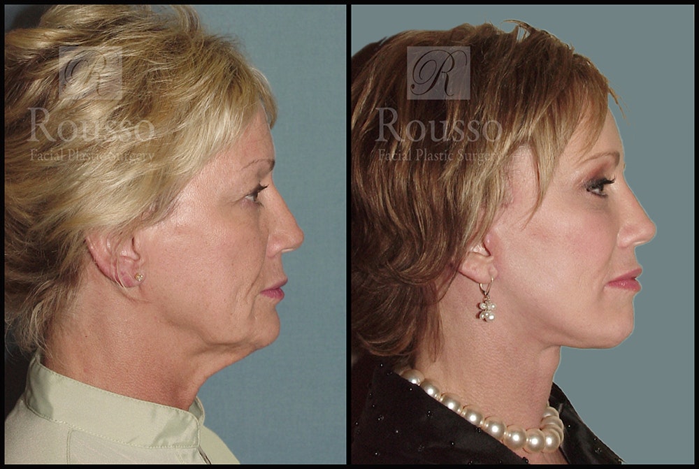 Facelift Gallery - Patient 1993263 - Image 1