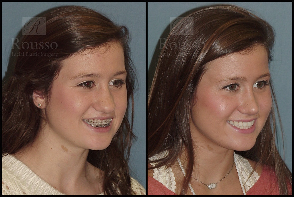 Rhinoplasty Before & After Gallery - Patient 25277298 - Image 2