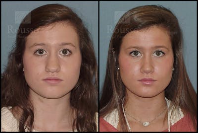 Rhinoplasty Before & After Gallery - Patient 25277298 - Image 2