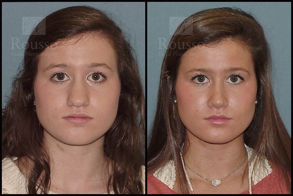 Rhinoplasty <span class=small>By Dr. Daniel Rousso</span> Before & After Gallery - Patient 25277298 - Image 3