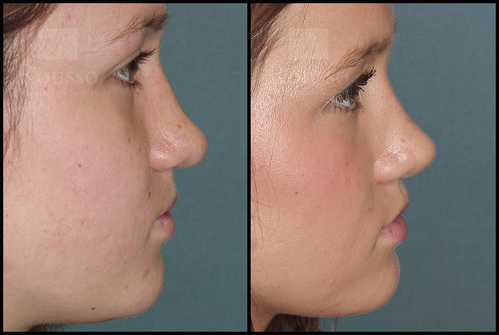 Rhinoplasty Before & After Gallery - Patient 25277298 - Image 3