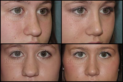 Rhinoplasty Before & After Gallery - Patient 25277298 - Image 4