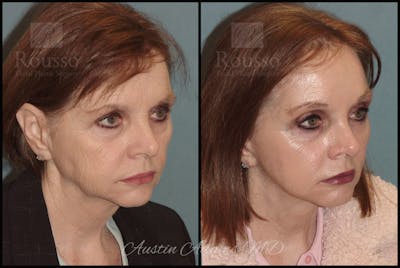 Facelift Before & After Gallery - Patient 25454294 - Image 1