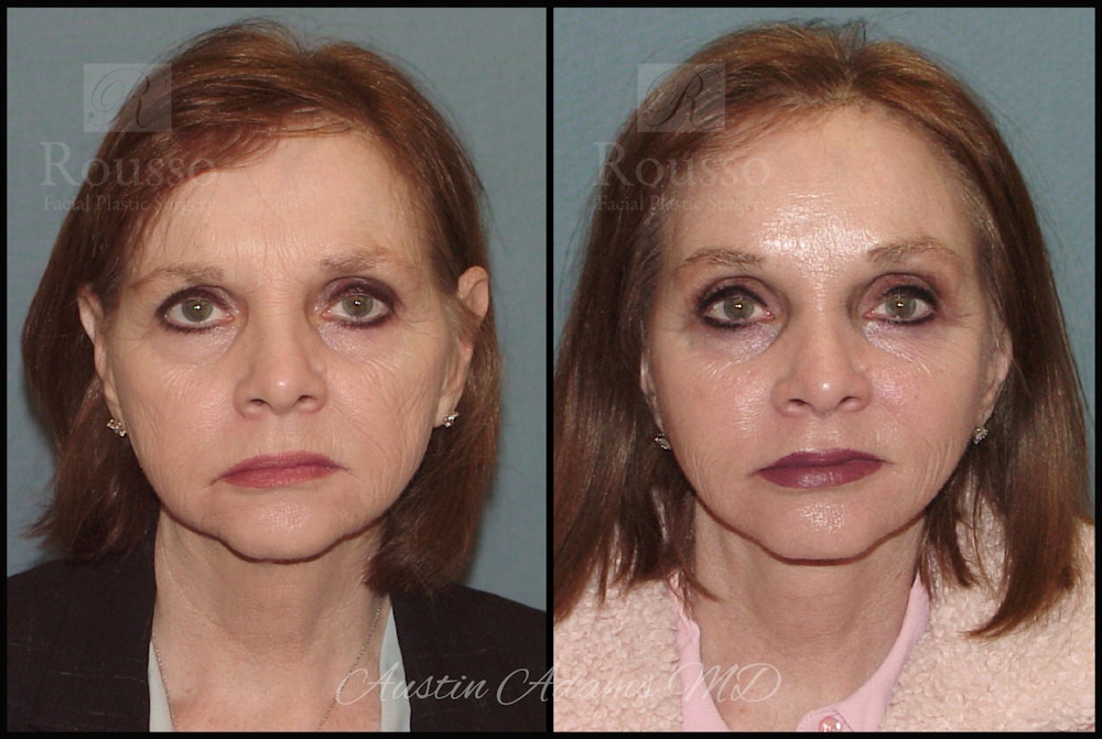 Facelift Before & After Gallery - Patient 25454294 - Image 3