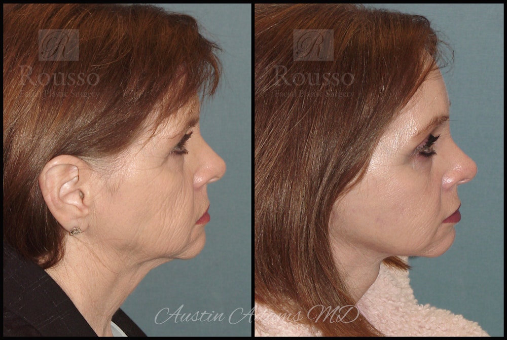 Facelift Before & After Gallery - Patient 25454294 - Image 2