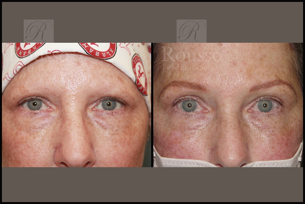 Microblading Gallery - Patient 26207210 - Image 1