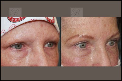 Microblading Gallery Before & After Gallery - Patient 26207210 - Image 2