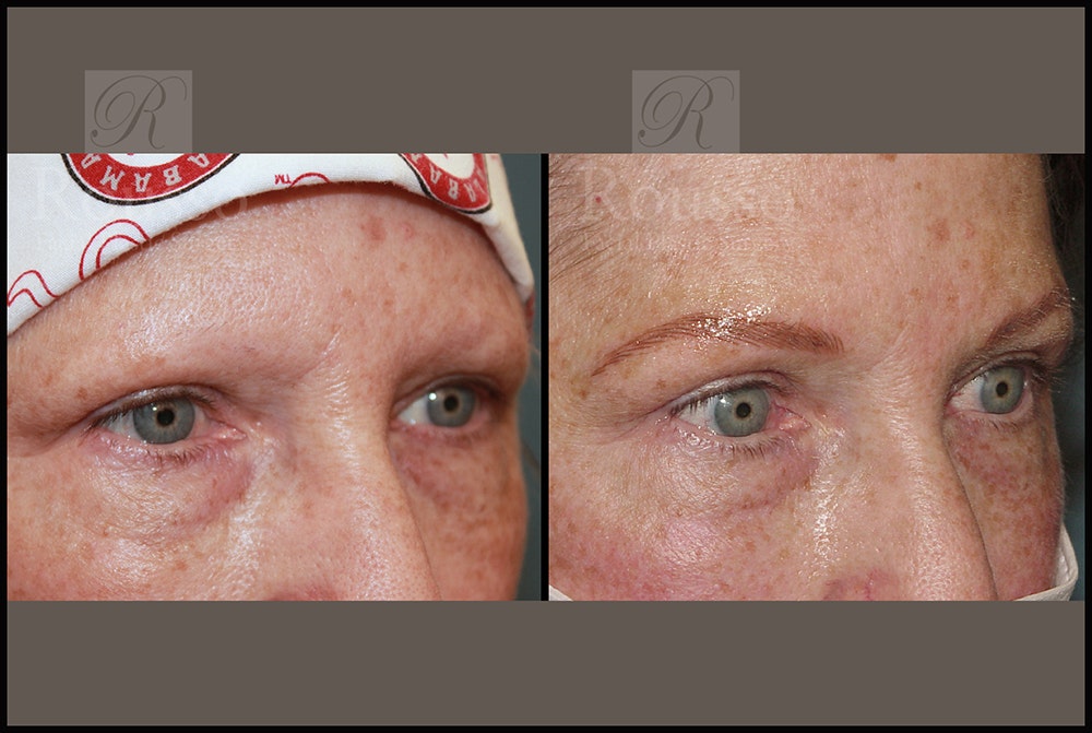 Microblading Gallery Before & After Gallery - Patient 26207210 - Image 2
