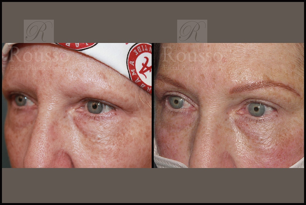 Microblading Gallery Before & After Gallery - Patient 26207210 - Image 3
