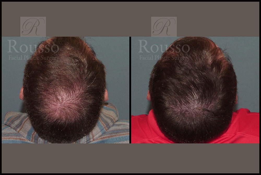 Scalp MicroPigmentation Before & After Gallery - Patient 26207216 - Image 3