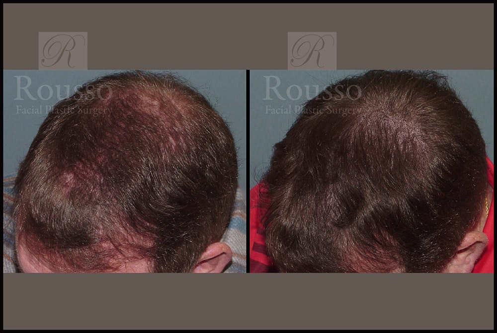 Scalp MicroPigmentation Before & After Gallery - Patient 26207216 - Image 1