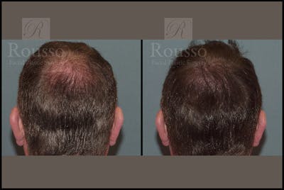 Scalp MicroPigmentation Before & After Gallery - Patient 26207216 - Image 2