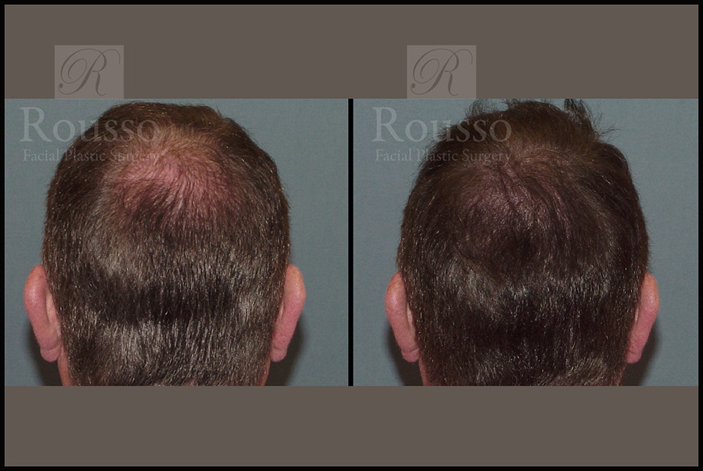 Scalp MicroPigmentation Before & After Gallery - Patient 26207216 - Image 2
