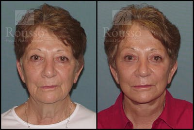 SculptLift™ Before & After Gallery - Patient 26207227 - Image 1