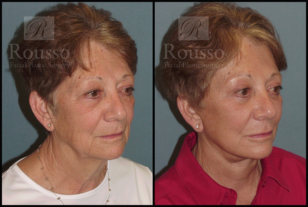 SculptLift™ Before & After Gallery - Patient 26207227 - Image 2