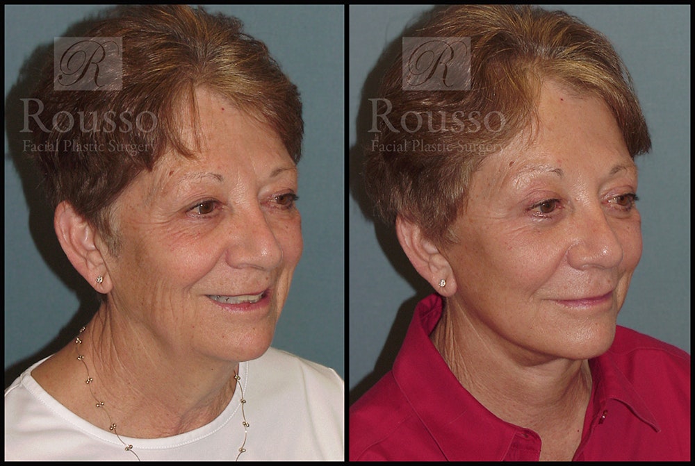 SculptLift™ Before & After Gallery - Patient 26207227 - Image 3
