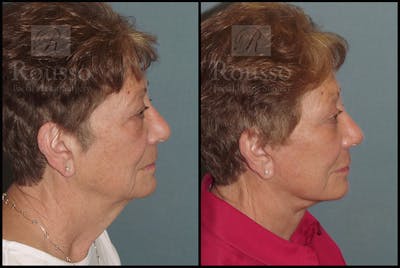 SculptLift™ Before & After Gallery - Patient 26207227 - Image 4