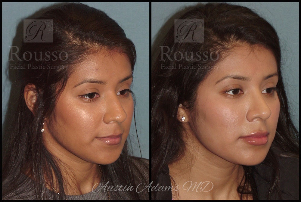 Rhinoplasty Before & After Gallery - Patient 26332664 - Image 1