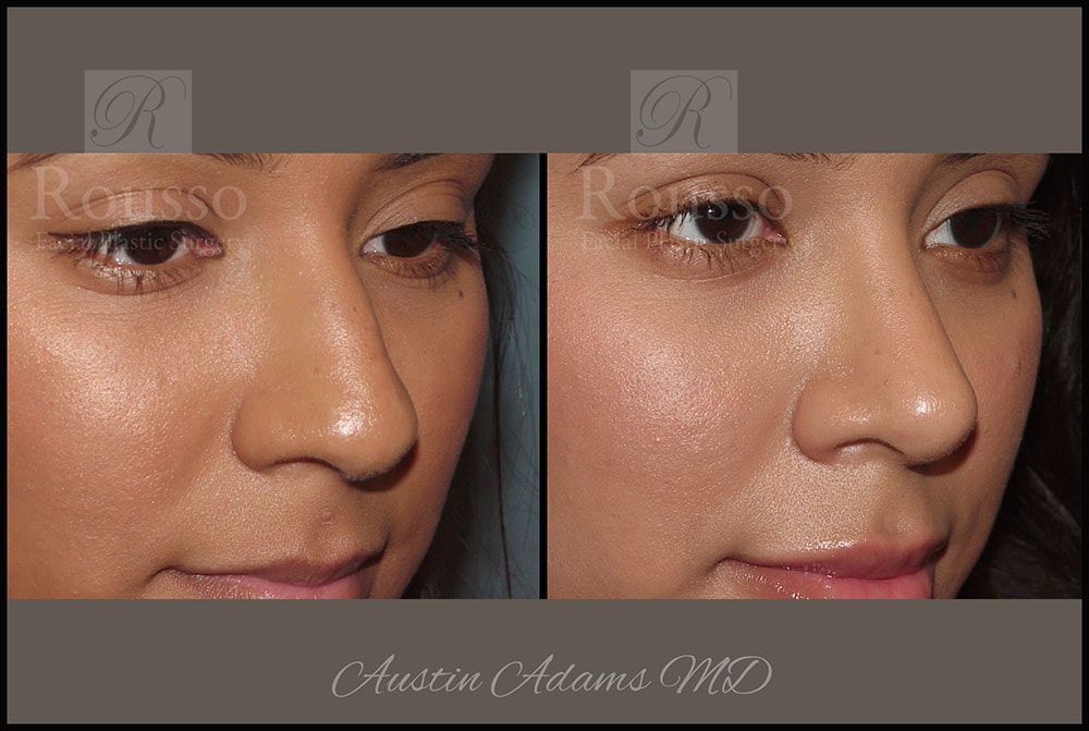 Rhinoplasty Before & After Gallery - Patient 26332664 - Image 4