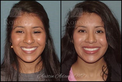 Rhinoplasty Before & After Gallery - Patient 26332664 - Image 2