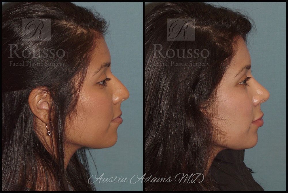 Rhinoplasty Before & After Gallery - Patient 26332664 - Image 3