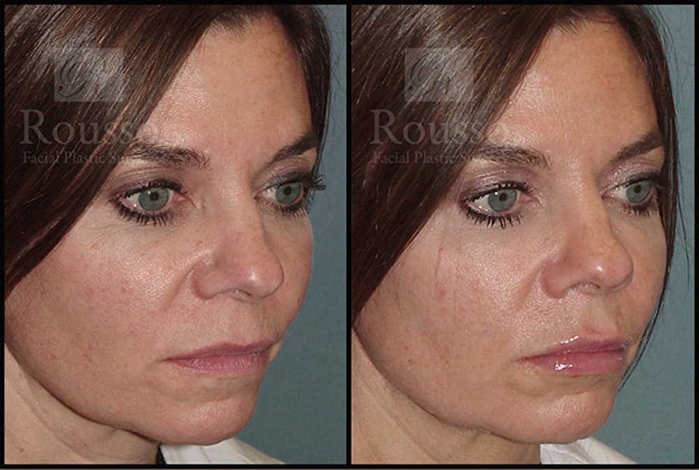 Fillers Before & After Gallery - Patient 5923191 - Image 1