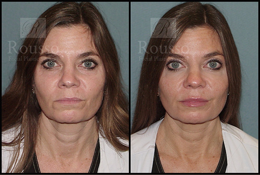 Fillers Before & After Gallery - Patient 5923191 - Image 2