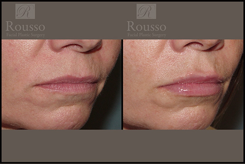 Fillers Before & After Gallery - Patient 5923191 - Image 3