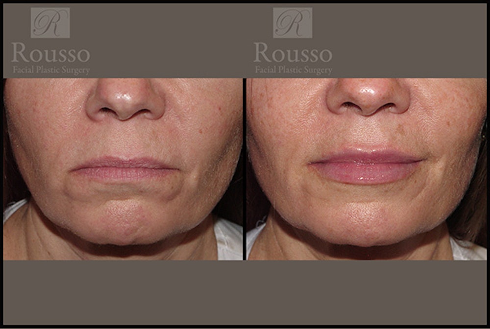 Fillers Before & After Gallery - Patient 5923191 - Image 4