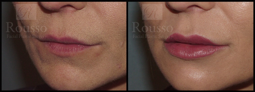 Fillers Gallery Before & After Gallery - Patient 26551171 - Image 1