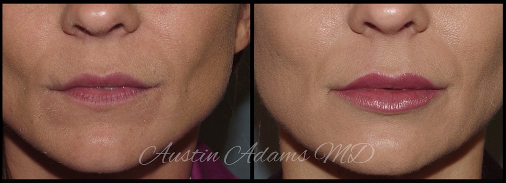 Fillers Gallery Before & After Gallery - Patient 26551171 - Image 2
