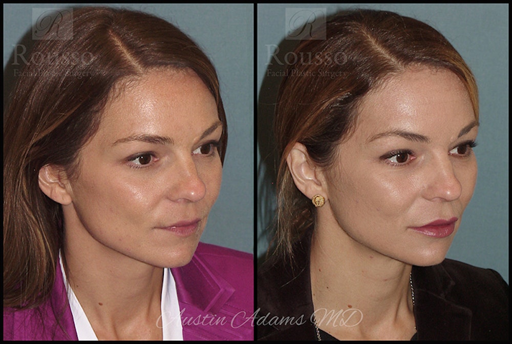 Fillers Before & After Gallery - Patient 26551171 - Image 3